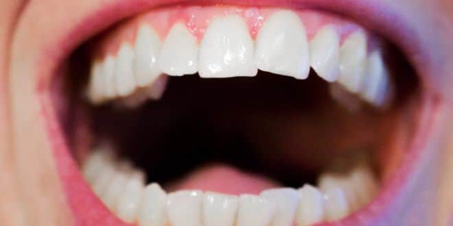 Zahnfleischrückgang: Eine sofortige Behandlung hilft beim Zahnerhalt